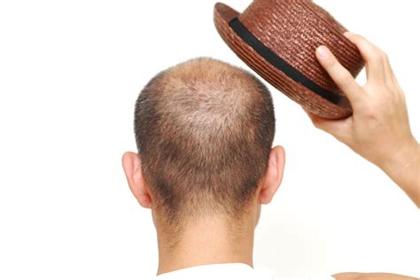 Does wearing hats cause baldness. Things To Know About Does wearing hats cause baldness. 